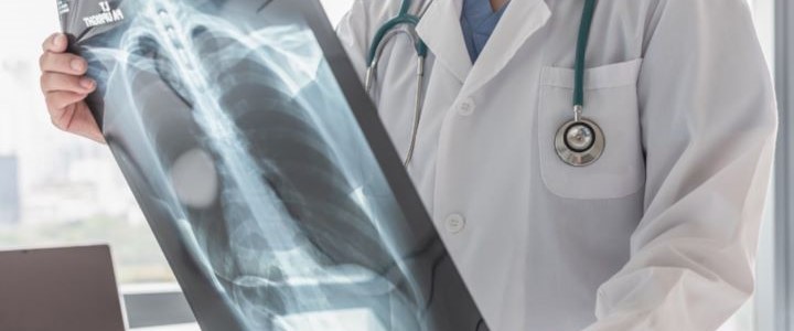 Cancer du poumon, symptômes et facteurs de risques.