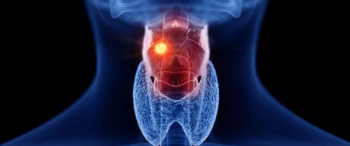 Cancers ORL : symptômes et facteur de risque 